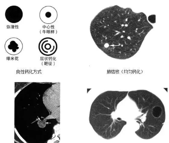 ct报告单提示有肺结节,但却弄不清良恶性?专家手把手教你