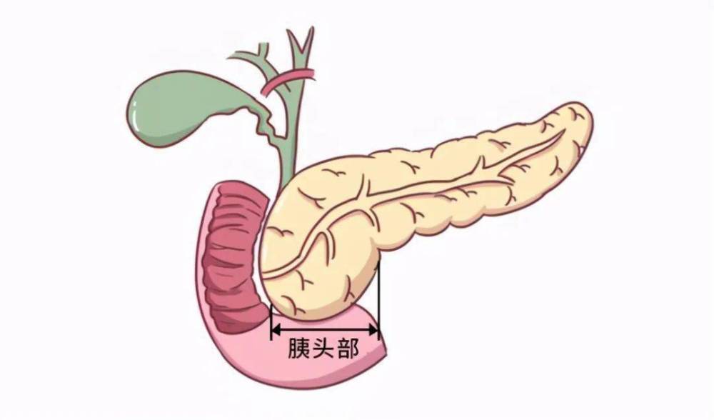 胰头癌治疗不能过于关注眼前还应注重总体预后的改善