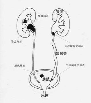 想碎医生却不给碎的尿结石,我们该拿它怎么办?