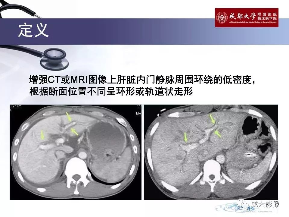 来源:成大影像 定义:增强ct或mri图像上肝脏内门静脉周围环绕的低