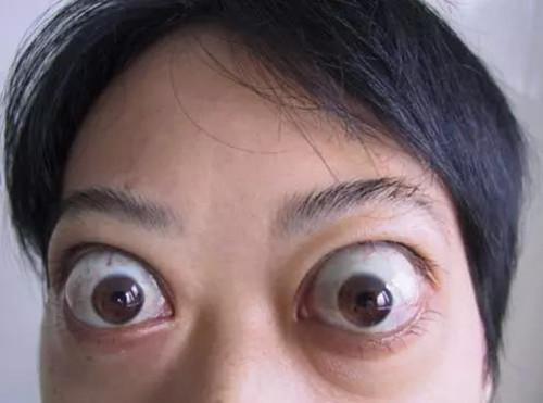 甲亢突眼的四个等级轻度突眼是黄金治疗时间