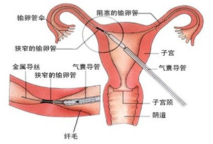 关于输卵管堵塞,你到底了解多少?