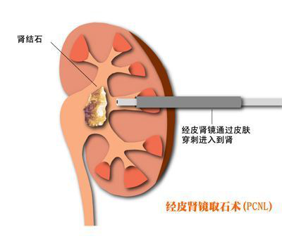 是指在b超引导或x光荧光透视监控下,通过经皮肾穿刺造瘘所建立的通道