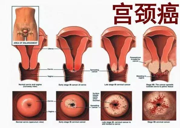 感染hpv不当回事,被诊为宫颈癌晚期!医生提醒:这3种症状别拖