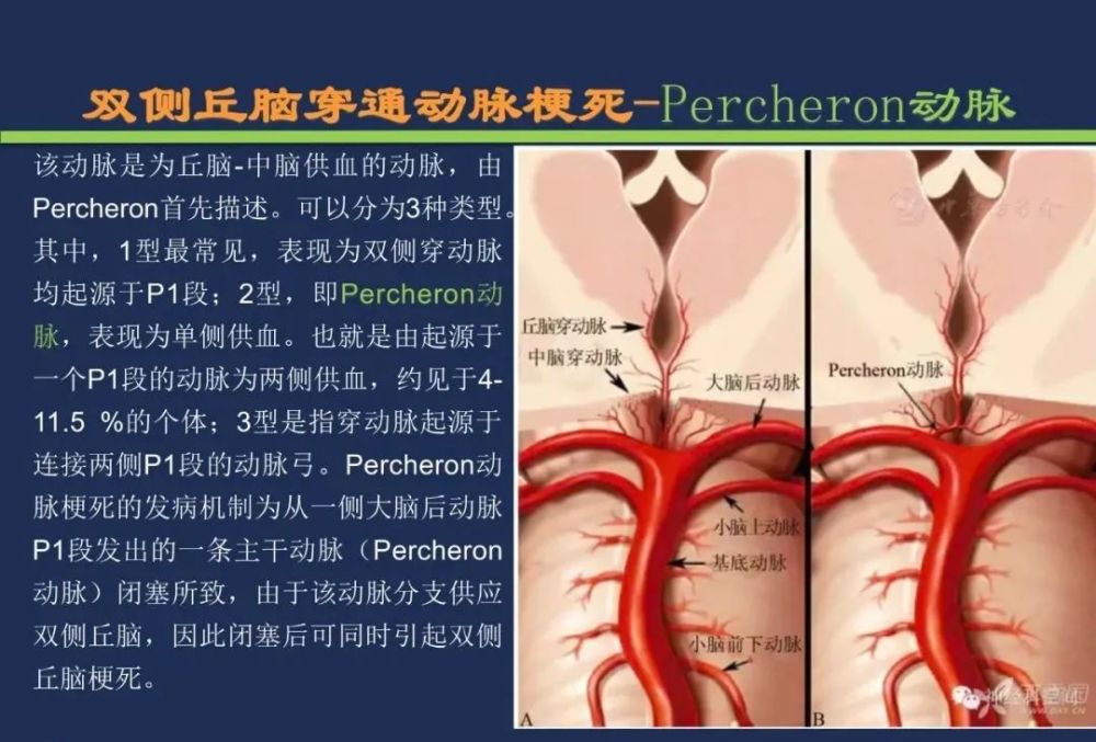 椎基底动脉梗死 大脑后动脉 丘脑穿通动脉-percheron动脉 丘脑结节