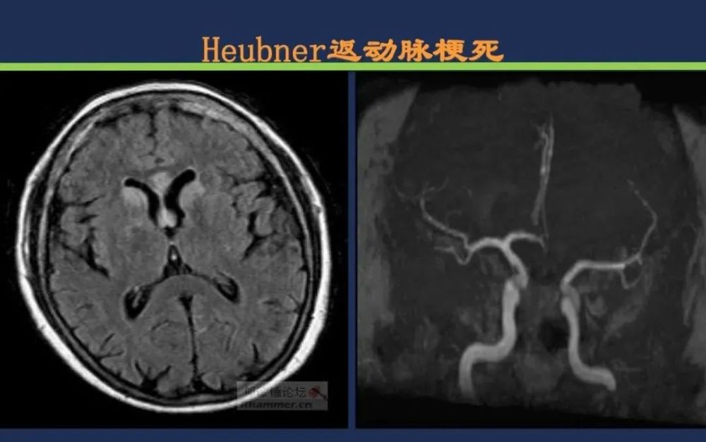 椎基底动脉梗死 大脑后动脉 丘脑穿通动脉-percheron动脉 丘脑结节