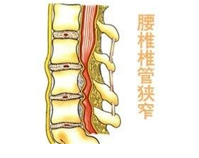 椎管狭窄(spinal stenosis)是各种原因引起椎管各径线缩短,压迫硬膜