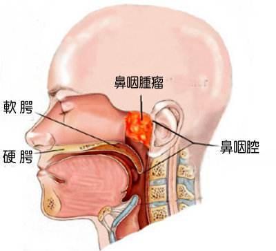 权威专家黄俭主任讲解:喉癌的早期症状有哪些