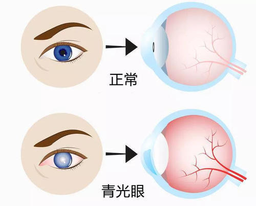 关系的亲属患有青光眼; 2,远视眼,年轻时视力特别好,花眼症状来得早的