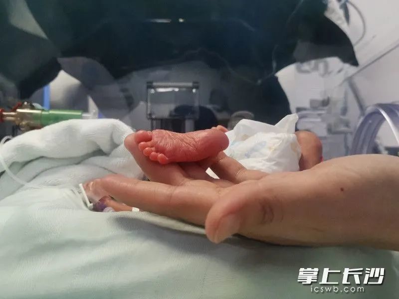 出生不到2斤!"巴掌宝宝"跑赢死神