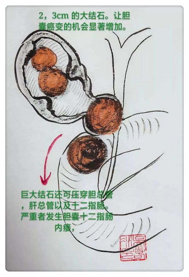 【图解】胆结石的危害:位置和大小的影响