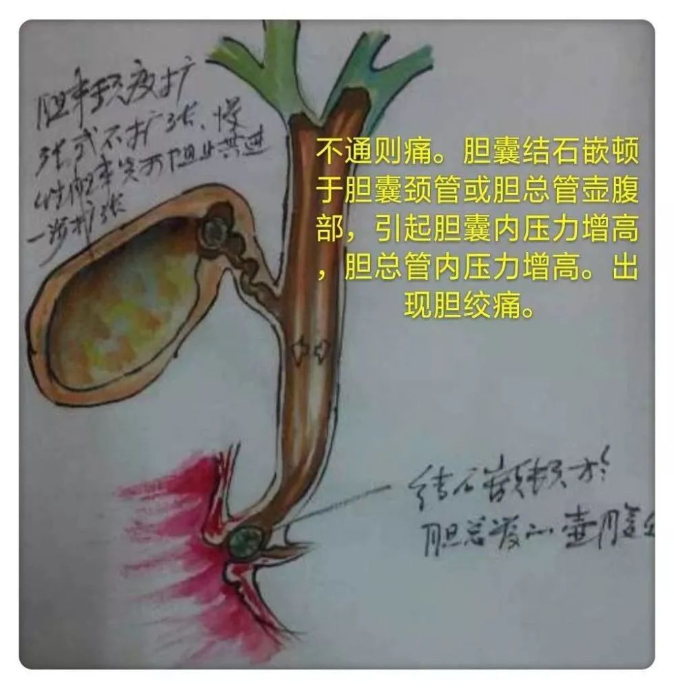 【图解】胆结石的危害:位置和大小的影响