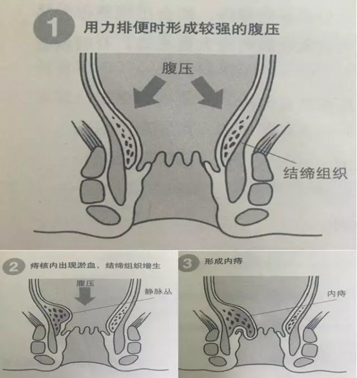 痔疮手术的后遗症