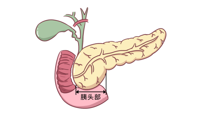 特别是 胰头癌的重要症状