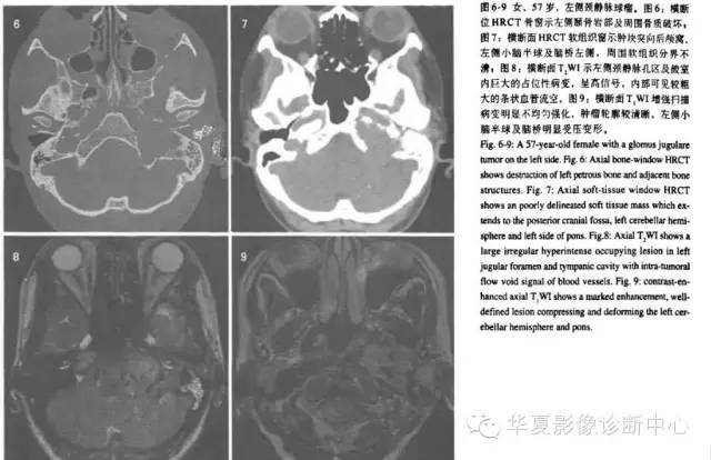 颈静脉球瘤