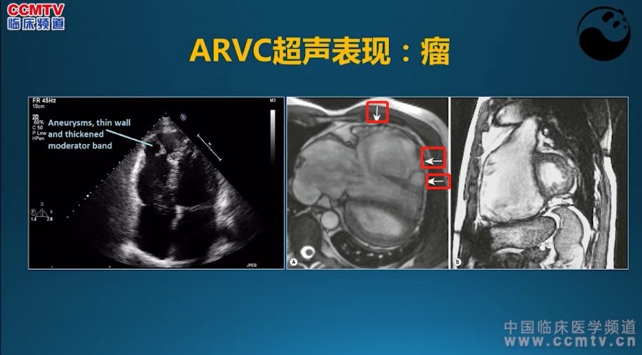5步法读懂超声心动图,90%的医生都不知道!