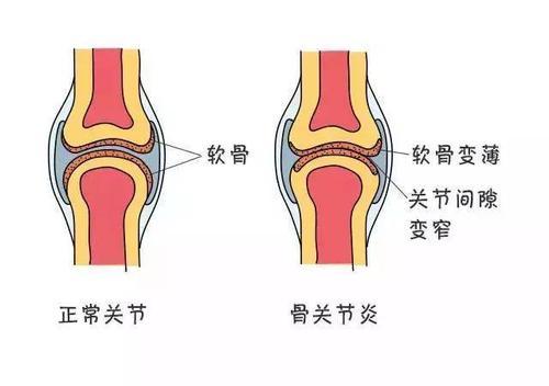 是不是得了骨关节炎哦!