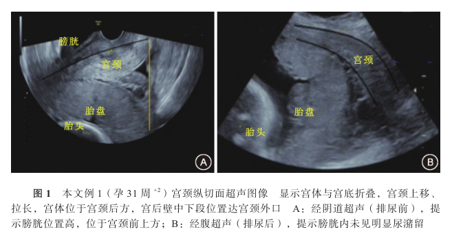 佳文分享妊娠子宫嵌顿四例的诊断与治疗