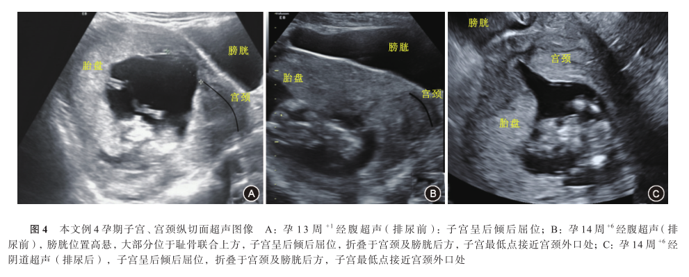 translucency, nt)厚度检查时,经腹超声示子宫后倾后屈位(图4),但超声