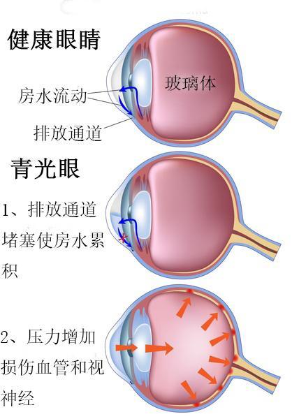 世界青光眼日远离青光眼你要做到这些