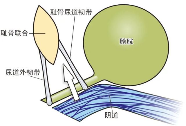 难以摆脱的"社交癌,女性压力性尿失禁_腾讯网