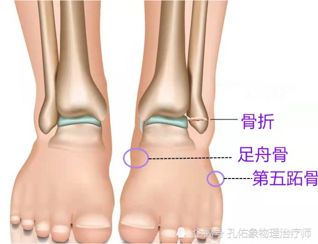 在脚的内,外踝上方6公分处按压有无疼痛;触摸第5跖骨,足舟骨部位有无