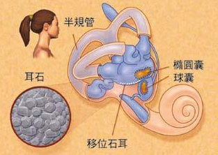 耳石症学名叫 "良性阵发性位置性眩晕"