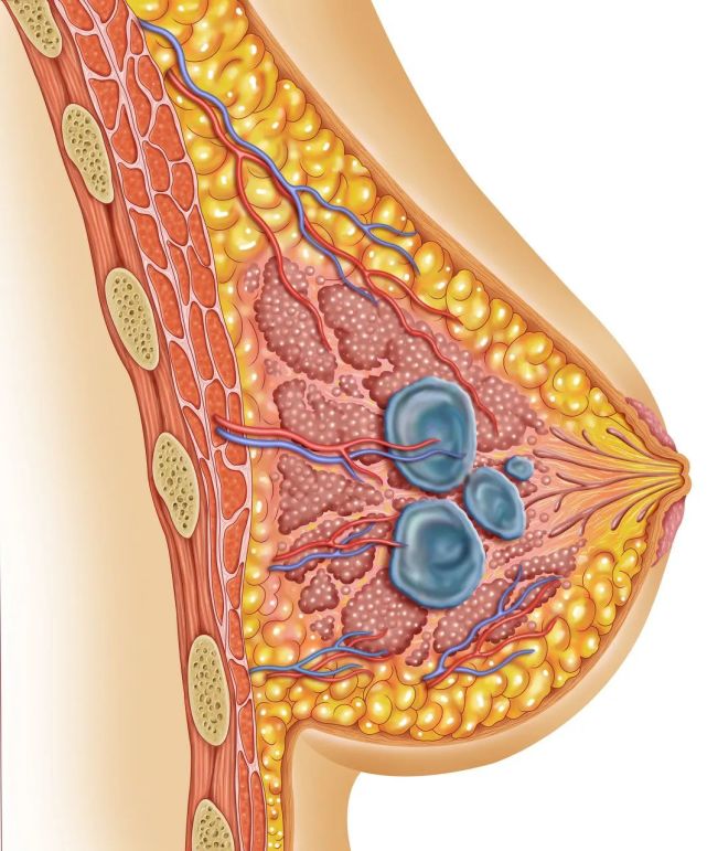 女神节揭秘乳腺结节经常乳房胀痛是不是摊上大事了