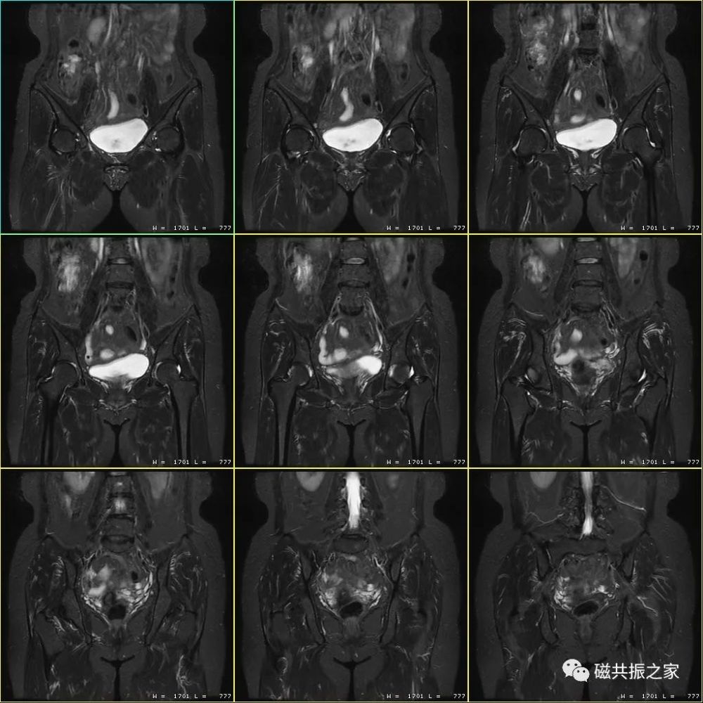 扫盲:骨盆mri该如何扫描!
