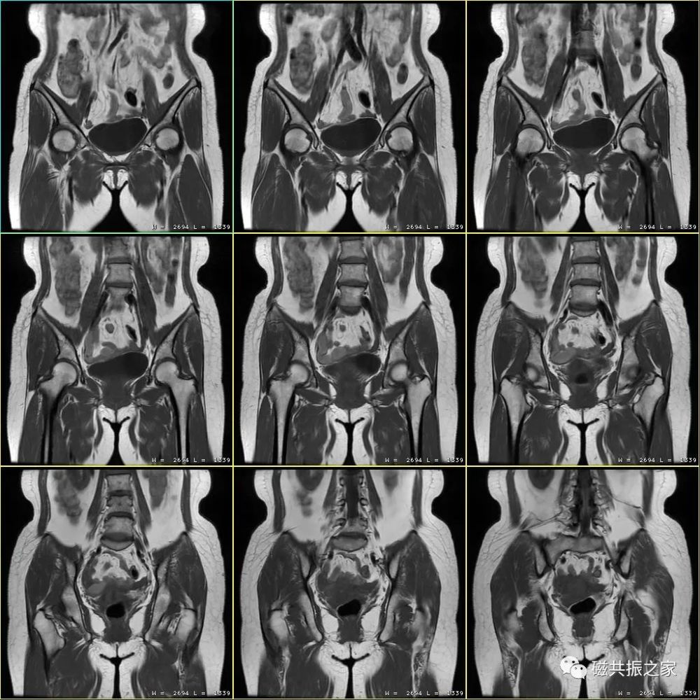 扫盲:骨盆mri该如何扫描!