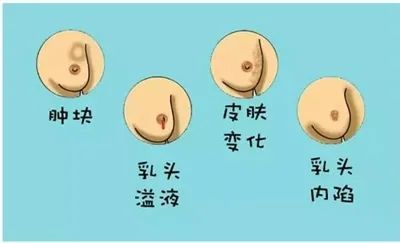 乳头改变:包括乳头溢液,乳头内陷或乳头湿疹样改变,如瘙痒,脱屑; 2.