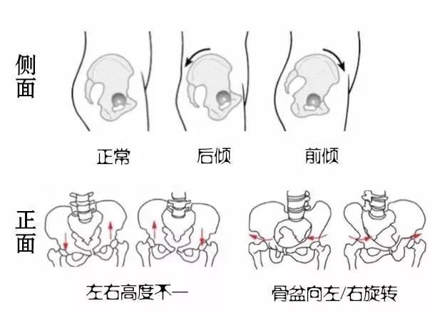 有些腰疼,可能是骨盆"歪"了!11道题自测骨盆倾斜度