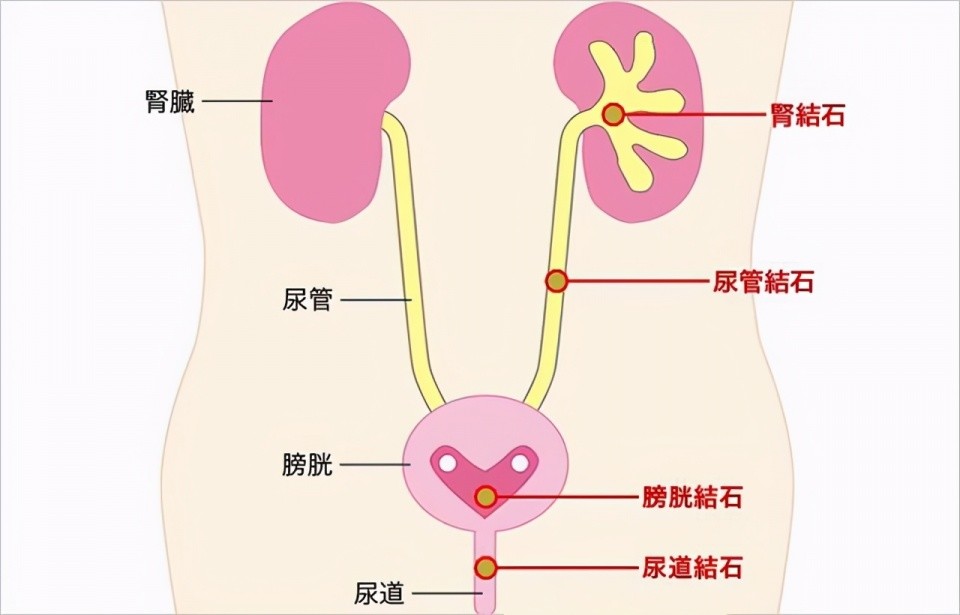 (3) 尿道里长东西:尿道中有息肉,肿瘤等,会使得尿道口变狭窄,可能对