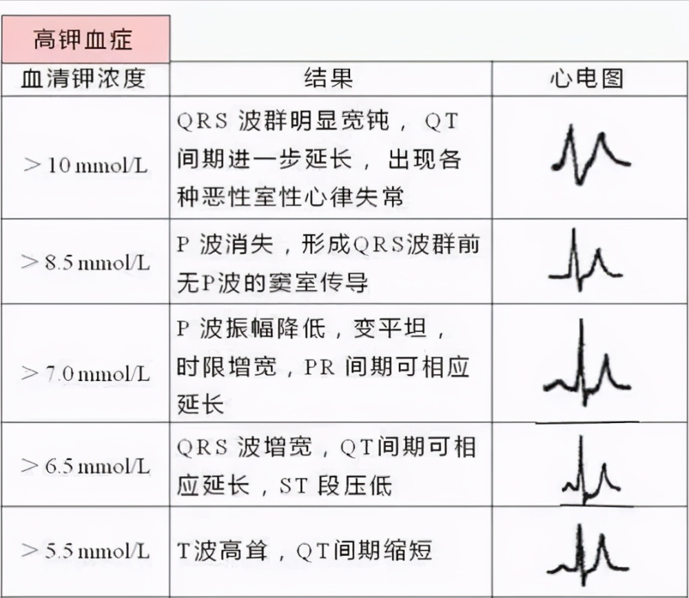 心电图显示t波高尖,可能提示哪些疾病?