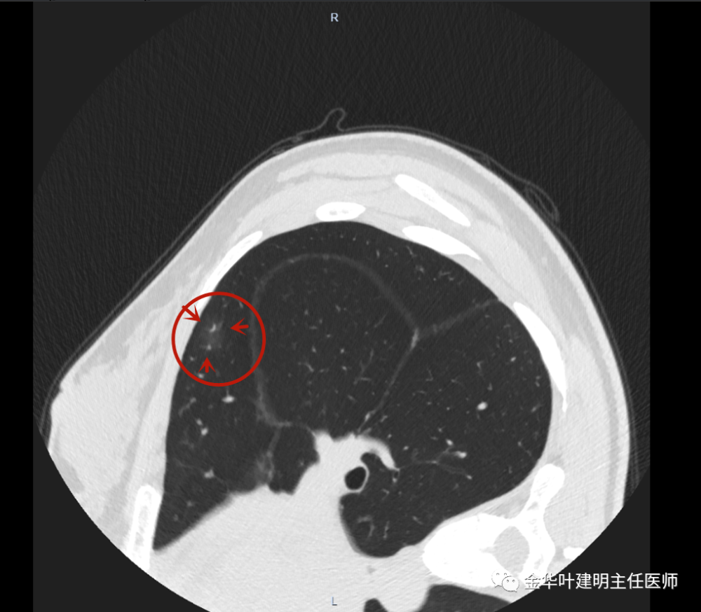 经验积累202139年轻的肺混合磨玻璃结节请复查一下
