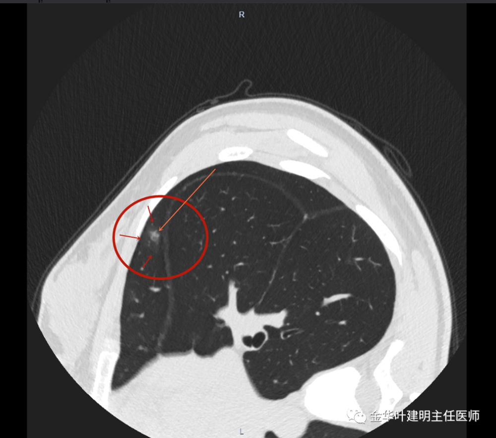 经验积累202139年轻的肺混合磨玻璃结节请复查一下
