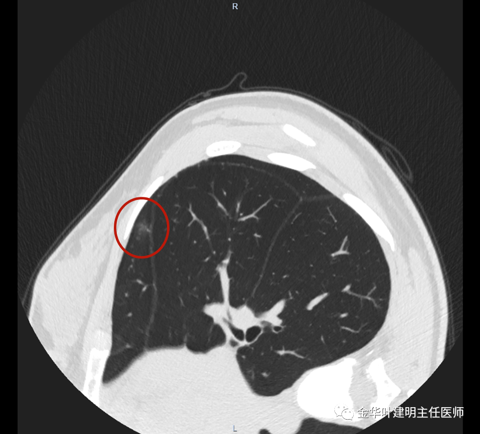 病灶有偏实性成份,与叶间裂较近,但牵拉不明显,磨玻璃部分密度较淡
