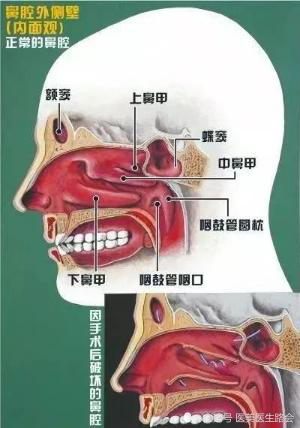 隆鼻1年后嗅觉减退是怎么回事