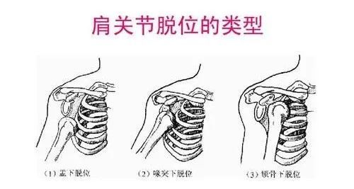 肩部变成方肩畸形,患侧手掌靠近胸部时,手掌不能搭在对侧肩部.