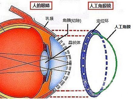 国产人工角膜要来了那一天他们终将看到