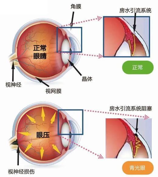 眼睛胀痛辗转宁波多家医院诊疗未果终在宁波博视眼科查明原因