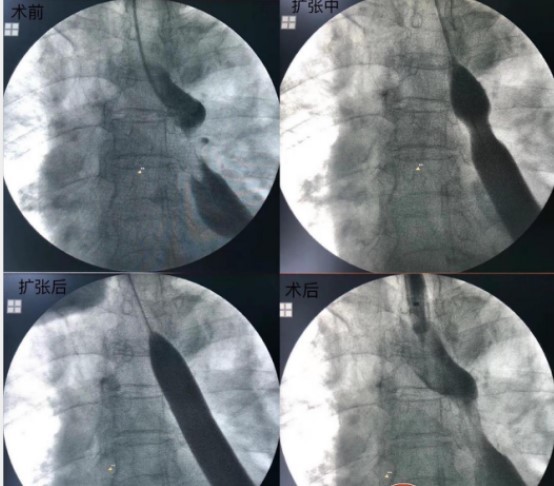 山东菏泽市第二人民医院成功实施首例食道球囊扩张术