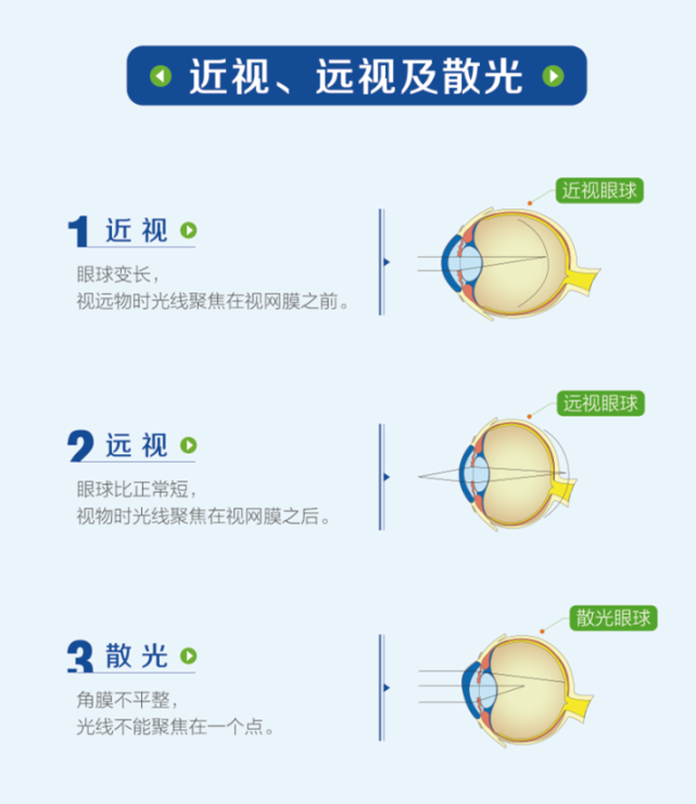其实"屈光不正"包含了我们常说的近视,远视,散光概念.