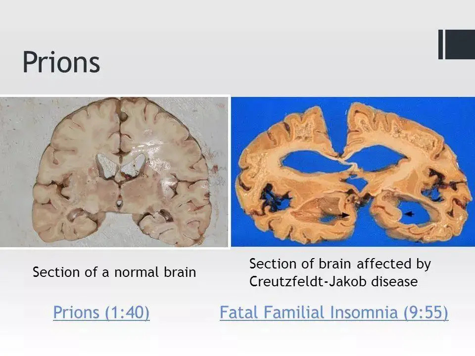 朊病毒——一个另类的病毒