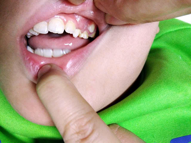 双排牙一般是两颗牙齿前后贴在一起,中间的缝隙小之又小.