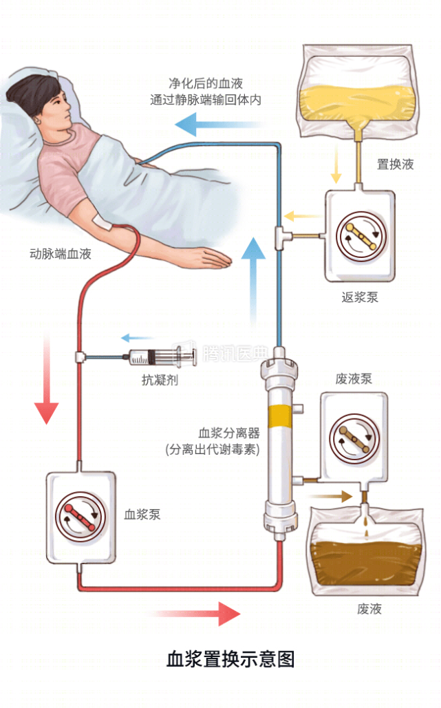 心血管疾病风险极高的人,才可能需要脂蛋白血浆置换,也就是血液净化治