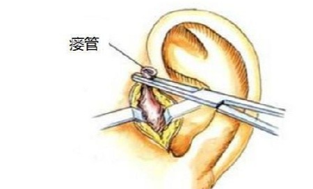 潍坊耳鼻喉医院如何预防耳前瘘管发炎