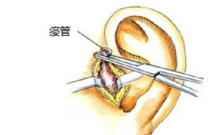 潍坊耳鼻喉医院:如何预防耳前瘘管发炎