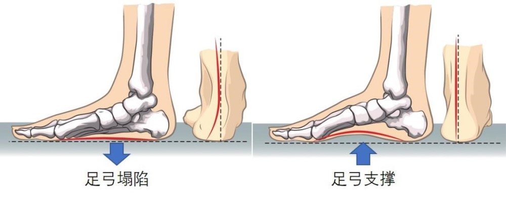 因此老年人内侧足弓弹性变差,足弓塌陷(图1,所以足部负重能力会大大