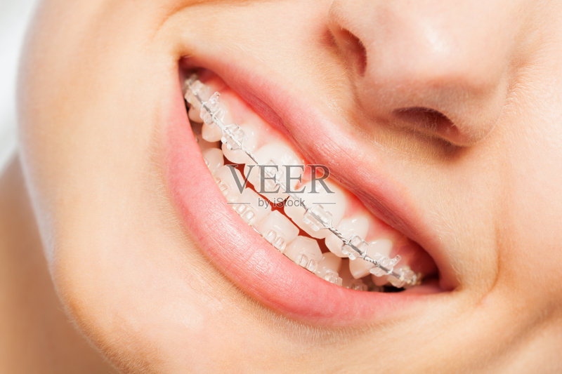 牙齿矫正戴牙套一般需要多久